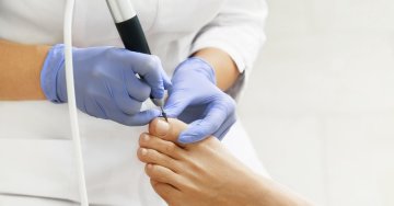 A bőrkeményedés, a tyúkszem, de még a magas fokú bőr