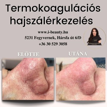Termokoagulációs értágulat és hajszáleresség kezelése