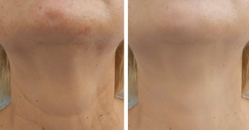 Újgenerációs HIFU kezelés az Individual Beauty szalonban