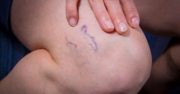 A betegség kezdetben leginkább esztétikai problémát jelent